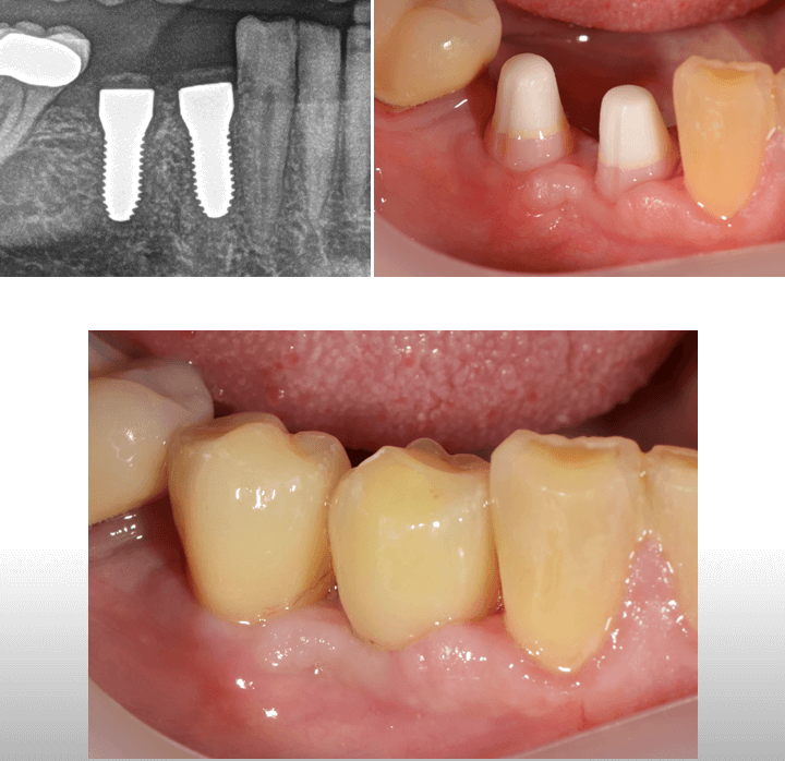 Keramikimplantate