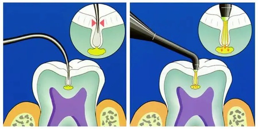 DIAGNODENT explorer vs diagnodent