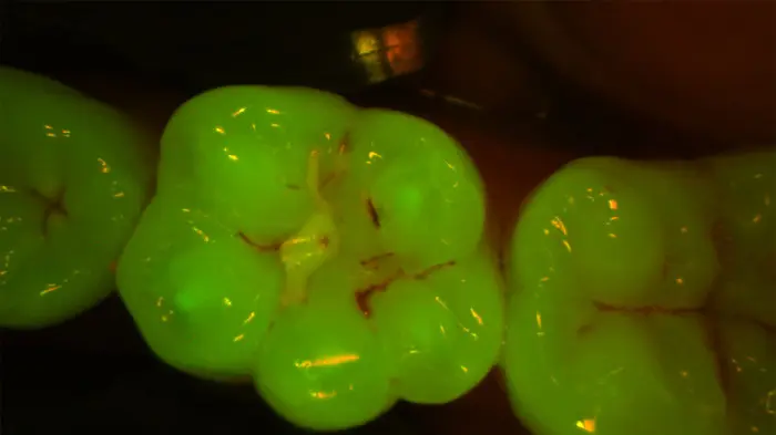 DIAGNOcam Vision Full HD Fluoreszenz Kariescheck