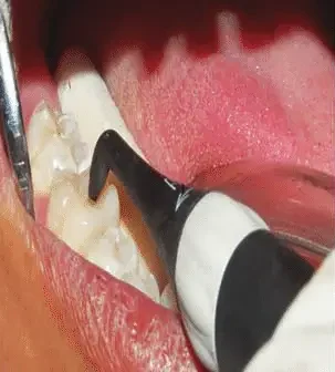 Diagnosis with DIAGNOdent Fig 4 Dye application