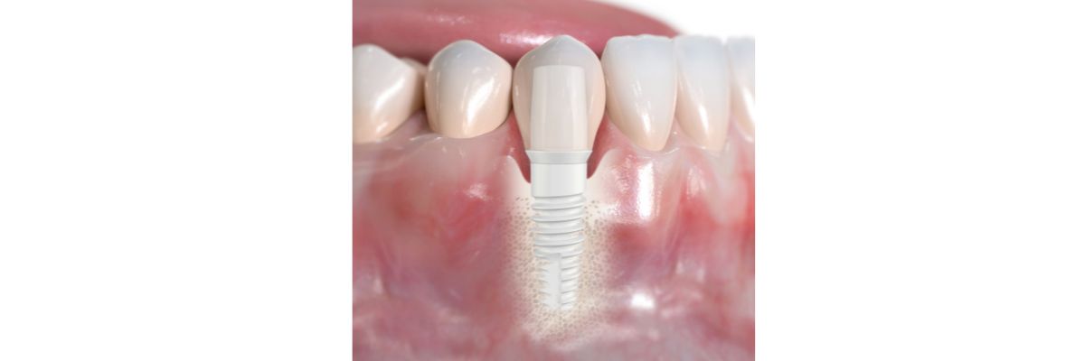 Header Implantate Sprechstunde