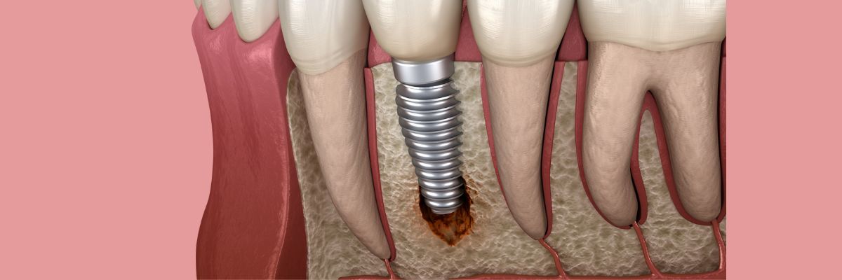 Header Sprechstunde Periimplantitis