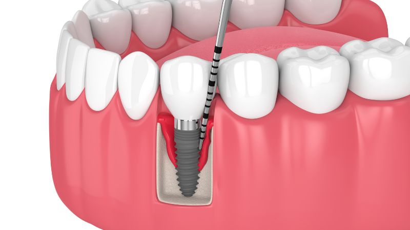 Periimplantitis